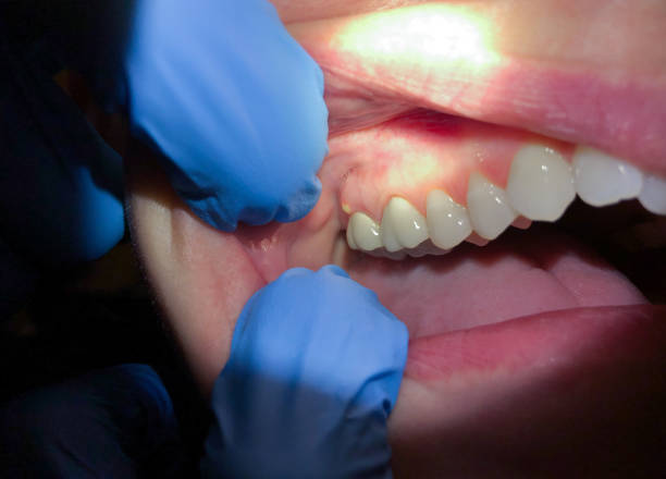 Best Emergency Treatment for Dental Infections or Abscesses in Eatons Neck, NY