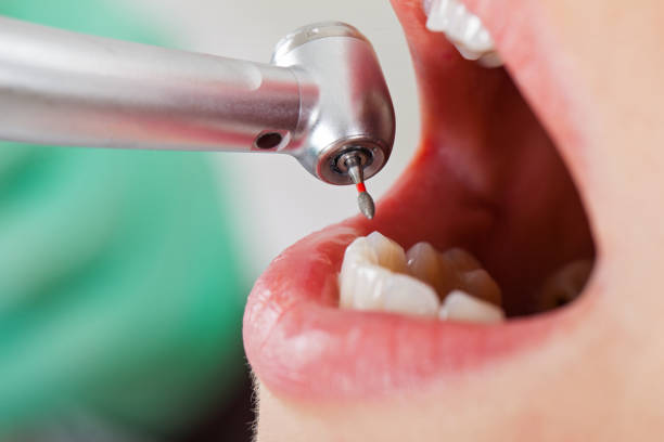 Best Emergency Tooth Extraction in Eatons Neck, NY